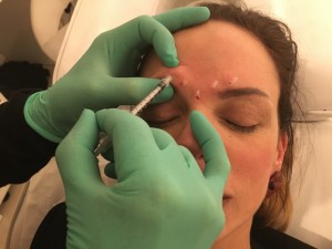 botox female client revive aesthetics middlesbrough