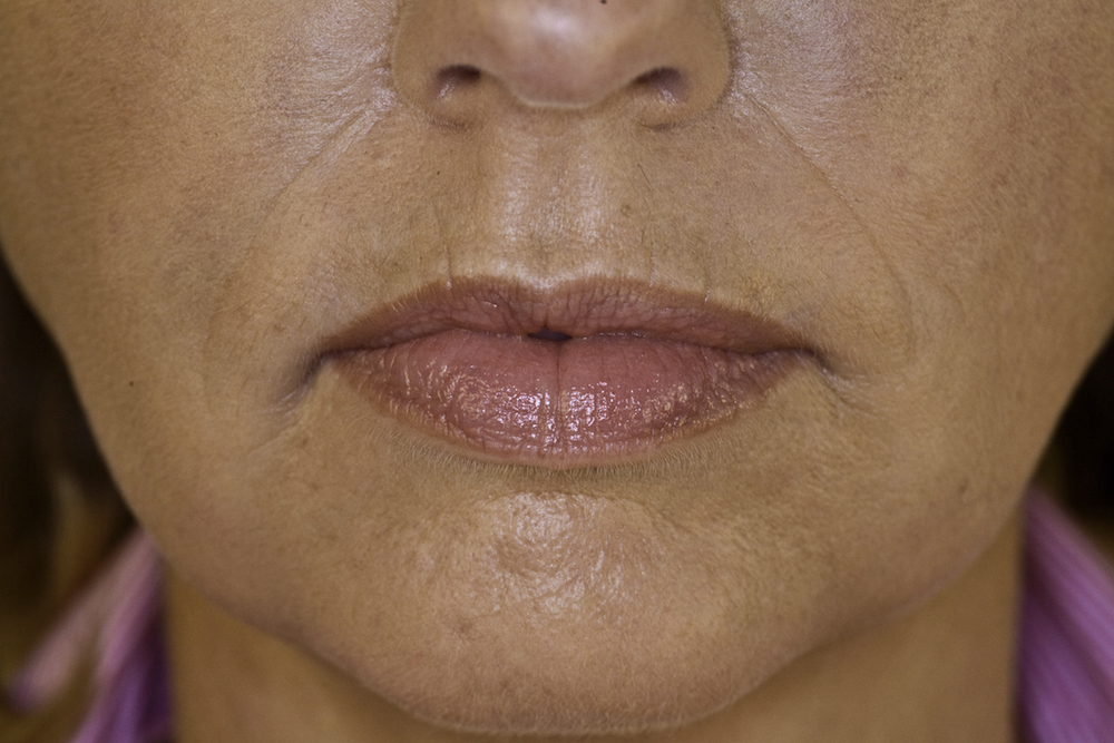 juvederm-lip-marionette-after