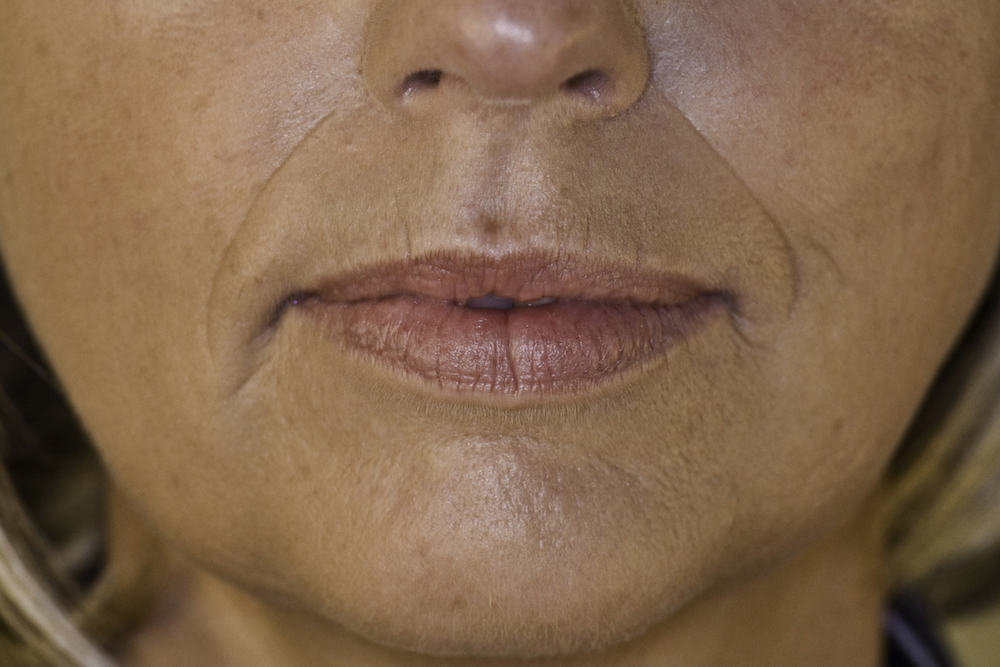 juvederm-lip-marionette-before