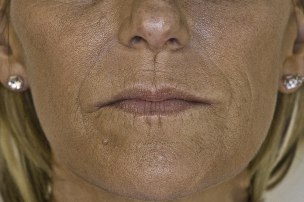 juvederm-nasolabial-after