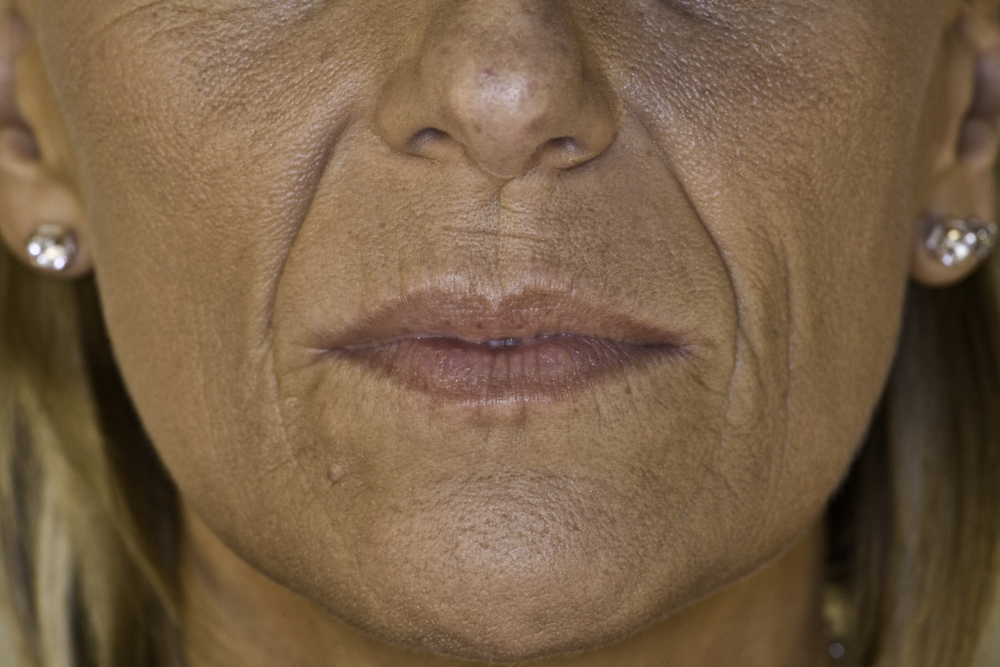 juvederm-lip-marionette-before