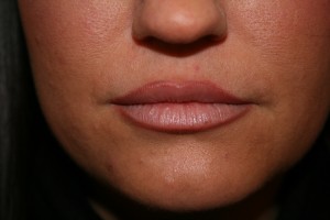 Belotero Lip After