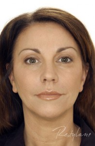 restylane dermal fillers after - middle aged woman