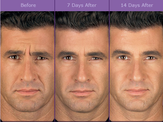 lines and wrinkles - before after male