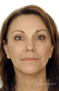 restylane dermal fillers - middle aged woman before